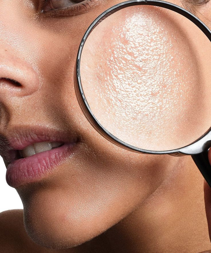 Acné, Poros e Imperfecciones