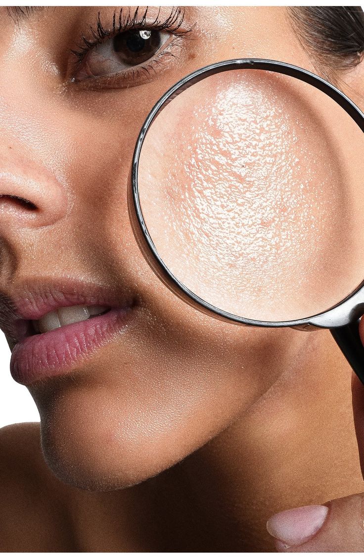 Acné e imperfecciones