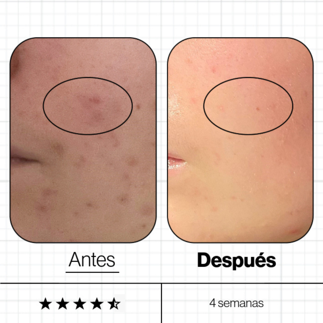 Advanced Nutrition Programme – Skin Clear Biome Imperfecciones