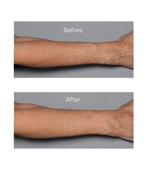 Perricone MD – Cold Plasma Plus+ Fragile Skin Therapy Tratamiento Piel Sensible y Fragilizada