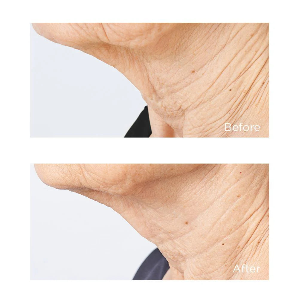 Perricone MD – Cold Plasma Plus+ Sub-D Neck Tratamiento Reafirmante Cuello y Papada