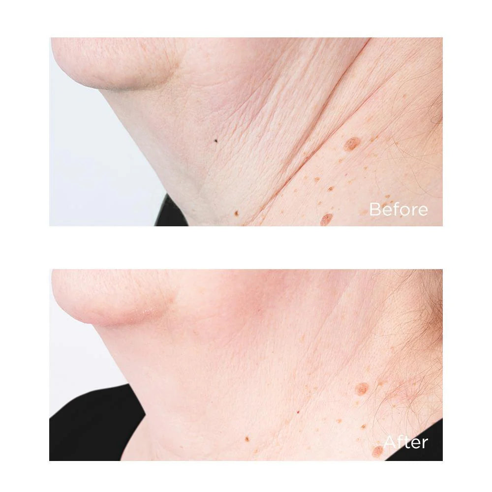 Perricone MD – Cold Plasma Plus+ Sub-D Neck Tratamiento Reafirmante Cuello y Papada