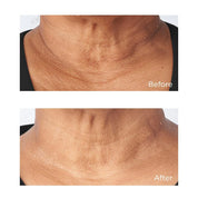 Perricone MD – Cold Plasma Plus+ Sub-D Neck Tratamiento Reafirmante Cuello y Papada
